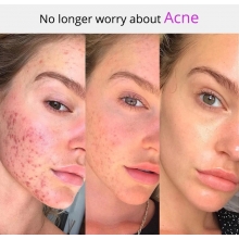 Electroderm Portabil Cosmetica cu 4 Capete Lumina Mov (Anti-Acnee) - 14